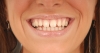 düzgün diş vs beyaz diş