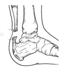 Asil Tendon Sakatligi Uludag Sozluk